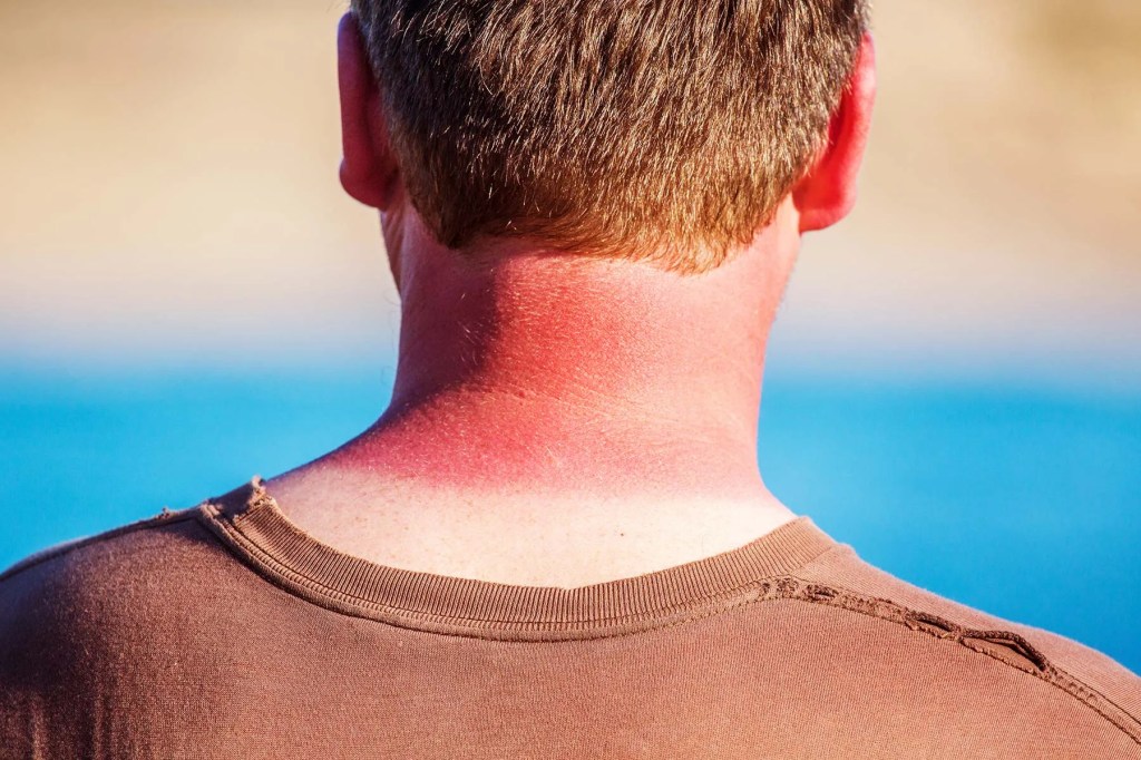 Dude, just wear&nbsp;sunblock